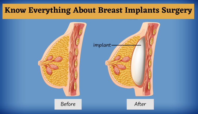Know Everything About Breast Implants Surgery