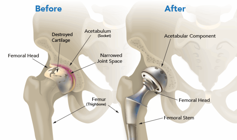 Joint Replacement Surgery