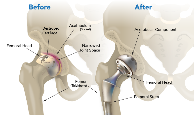 Joint Replacement Surgery