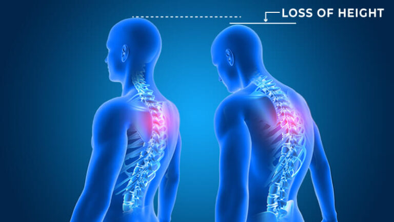 Loss of Height Treatment