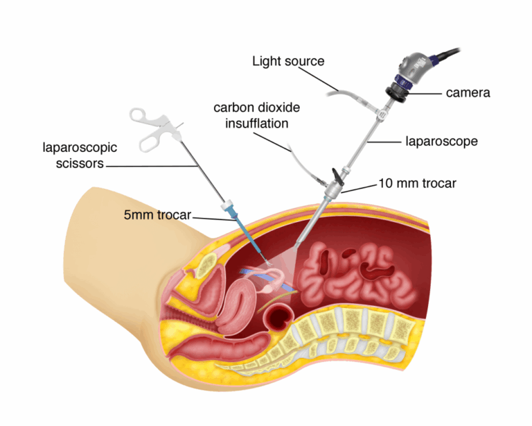 Laparoscopic Surgery