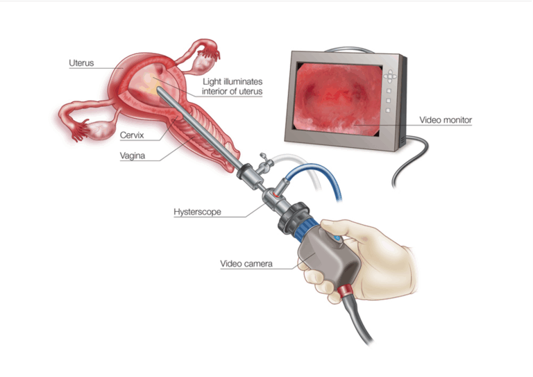 Hysteroscopy Surgery