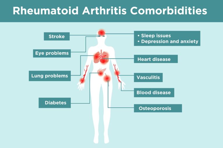 Primary Care Rheumatology – SLE & Various Arthritis