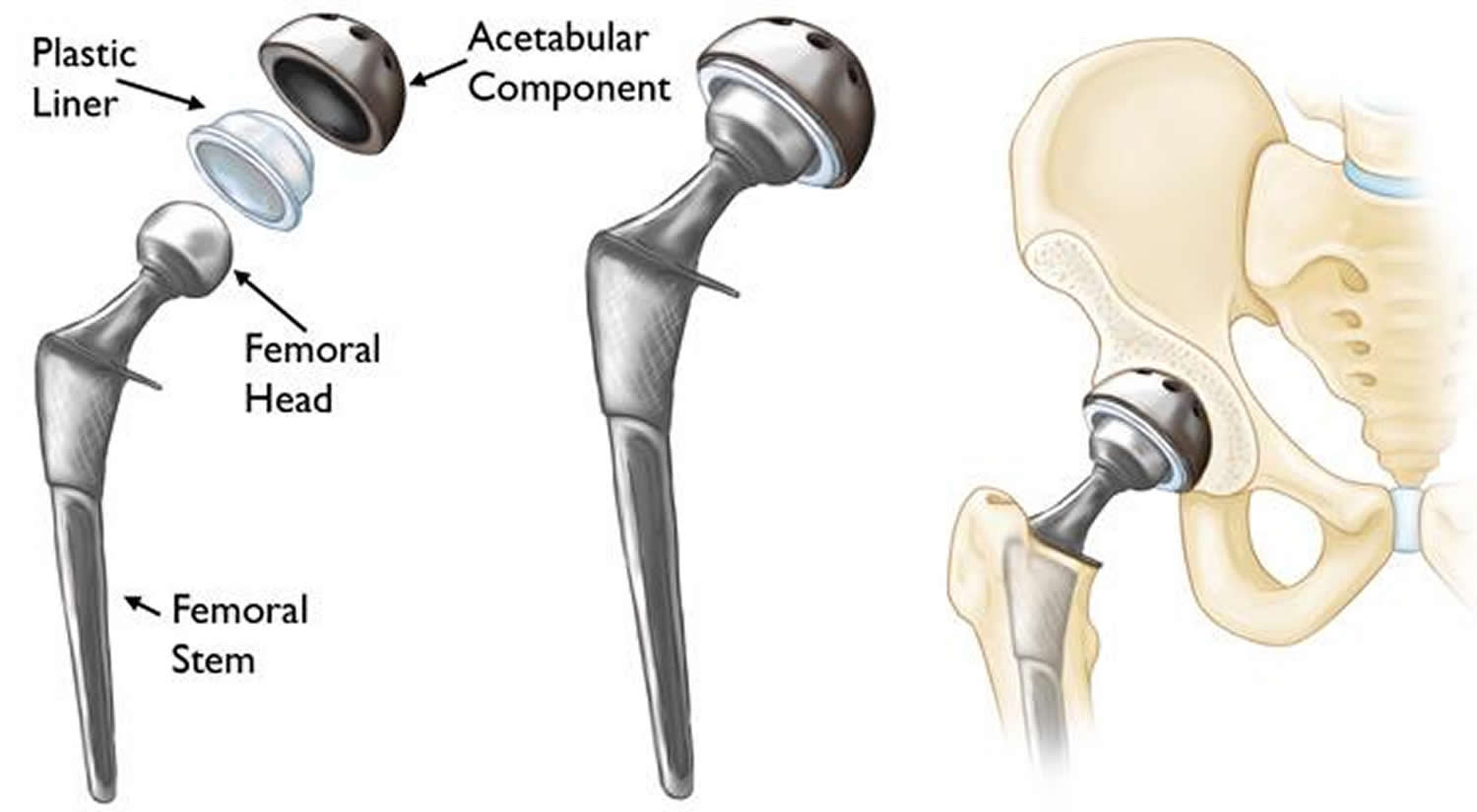 Hip Replacement Surgery