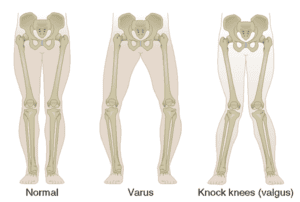 Crooked legs