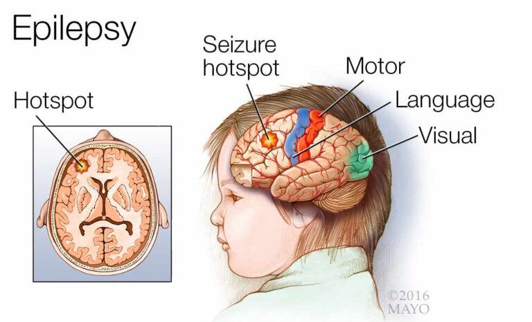 Neurological Illness – Epilepsy / Stroke