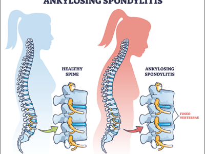 Spondylitis Treatment