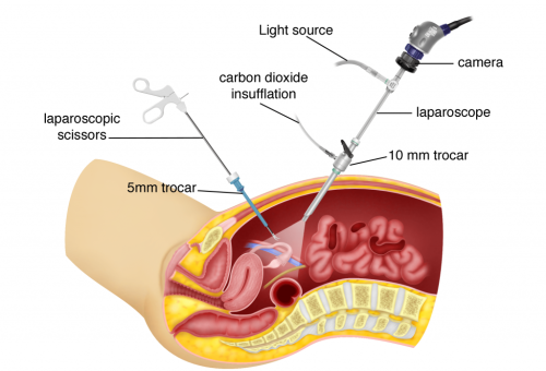 Laparoscopic Surgery