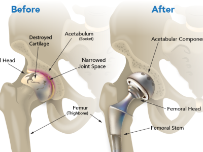 Joint Replacement Surgery