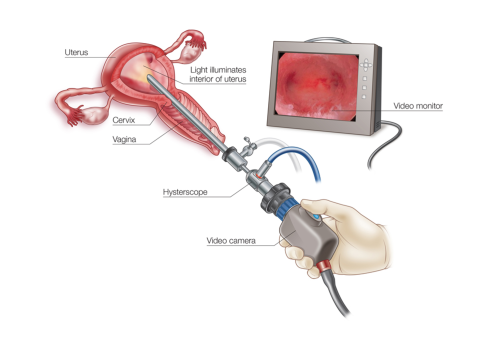 Hysteroscopy Surgery