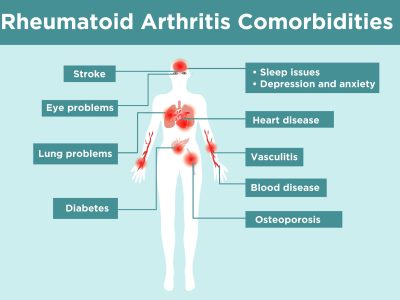 Primary Care Rheumatology – SLE & Various Arthritis