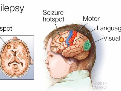 Neurological Illness – Epilepsy / Stroke