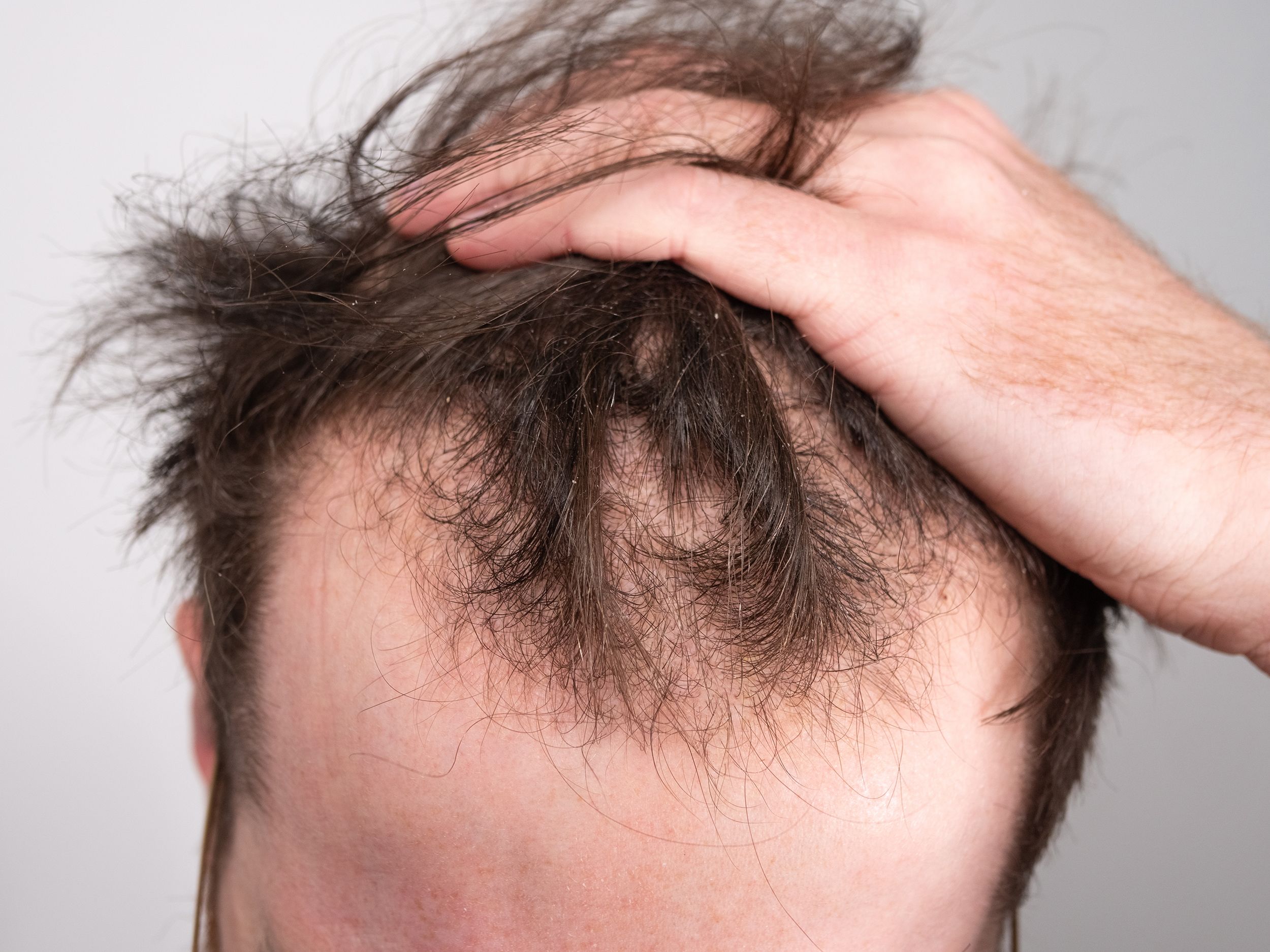 Hair Loss (Baldness)